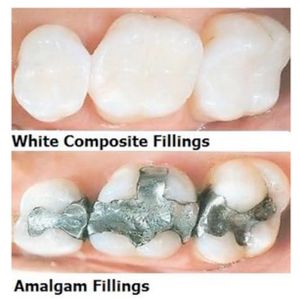 Composite fillings replacing metal fillings