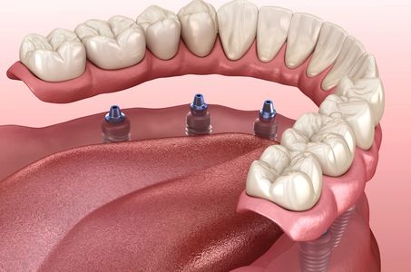 Overdenture to support toothless ridge