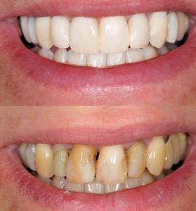 Before and after using dental veneers and crowns