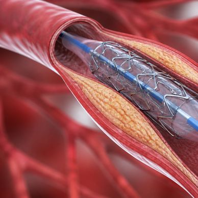 Medical illustration of a stent being placed in a narrowed artery.