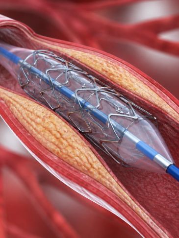 A stent is placed inside a narrowed artery to restore blood flow.