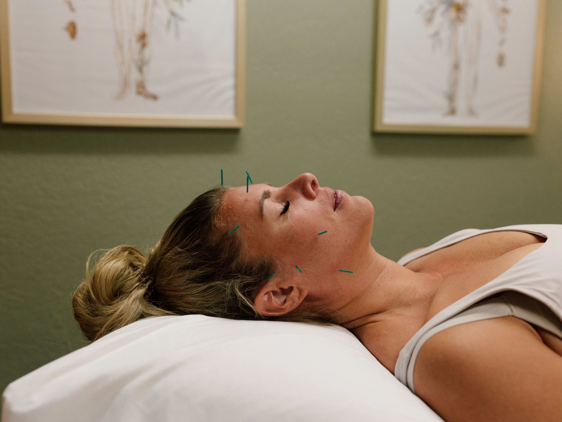 facial cosmetic acupuncture
