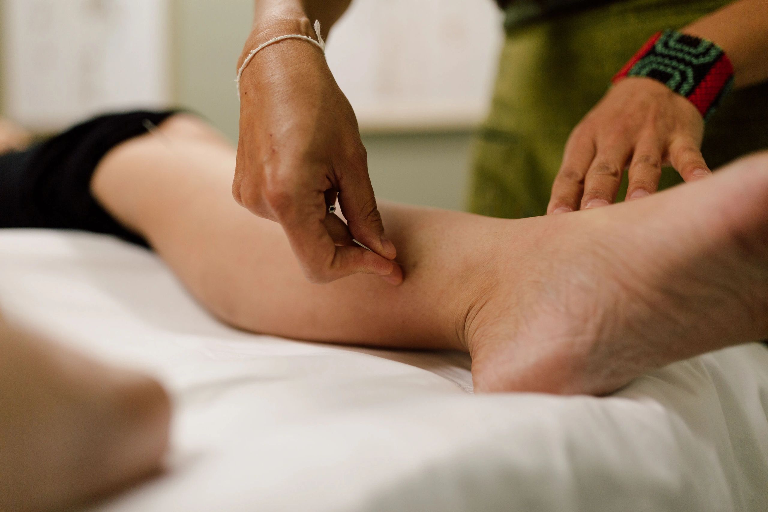 acupuncture needle being inserted on the leg