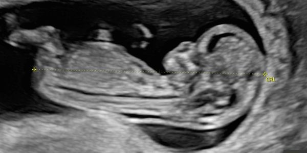 2d-reassuance-baby-scan-image