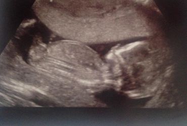 2d-babyscan-sonography-little-miracles-oldham-growth-scan-delph