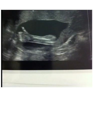 2d-ultrasound-picture-thumbs-up