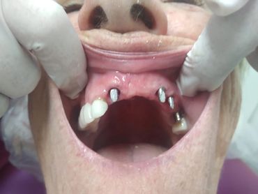 Antes de rehabilitación sobre implantes: