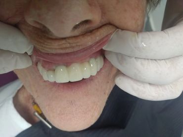 despues de rehabilitación sobre implantes: