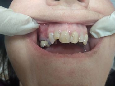 Antes de diseño de sonrisa