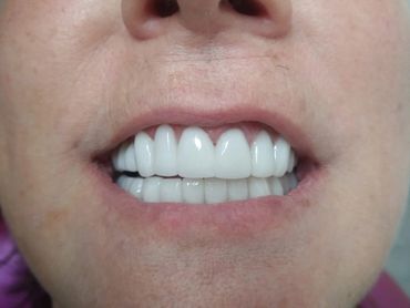 Despues de diseño de sonrisa