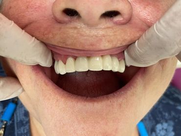 Después de Implantes