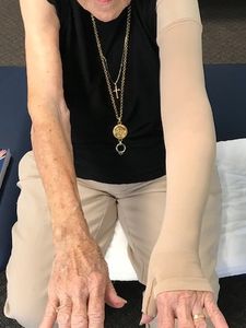 Breast Cancer Survivor with Left Upper Extremity Lymphedema wearing compression garment