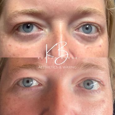 Derma 2.0 Bio to restore the under-eye area, reducing dark circles and a sunken appearance.