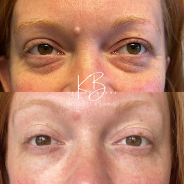 Derma Bio 2.0 for under-eye bags.