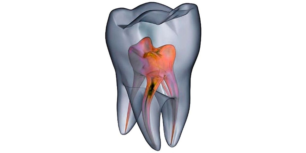 Ilustración médica de un diente con estructura interna visible.