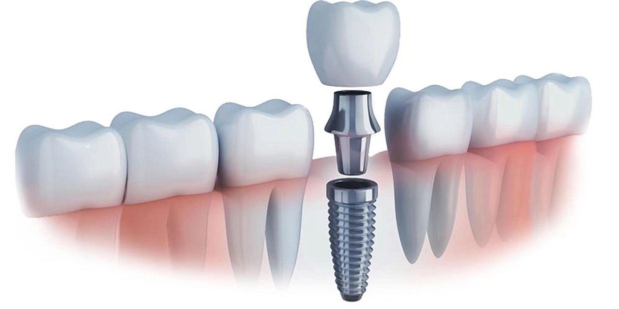 Diseño de Sonrisa, Odontología, Carillas dentales, Carillas de Resina, Diseño, Dientes, Sonrisa