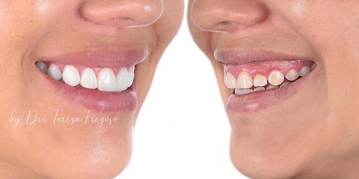 Diseño de Sonrisa, Odontología, Carillas dentales, Carillas de Resina, Diseño, Dientes, Sonrisa