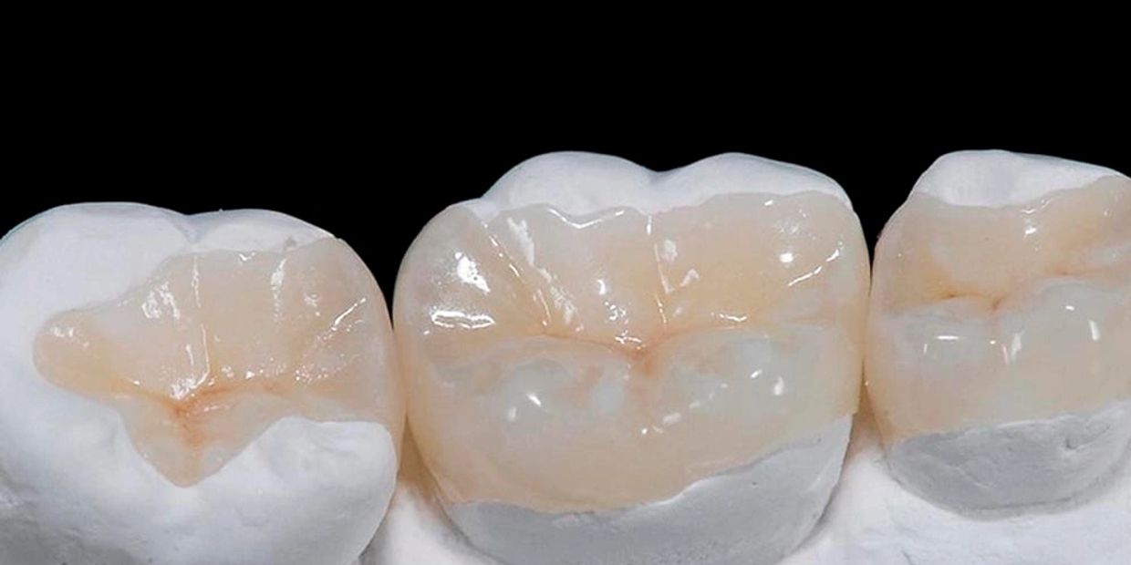 Modelo de dientes con restauraciones dentales.