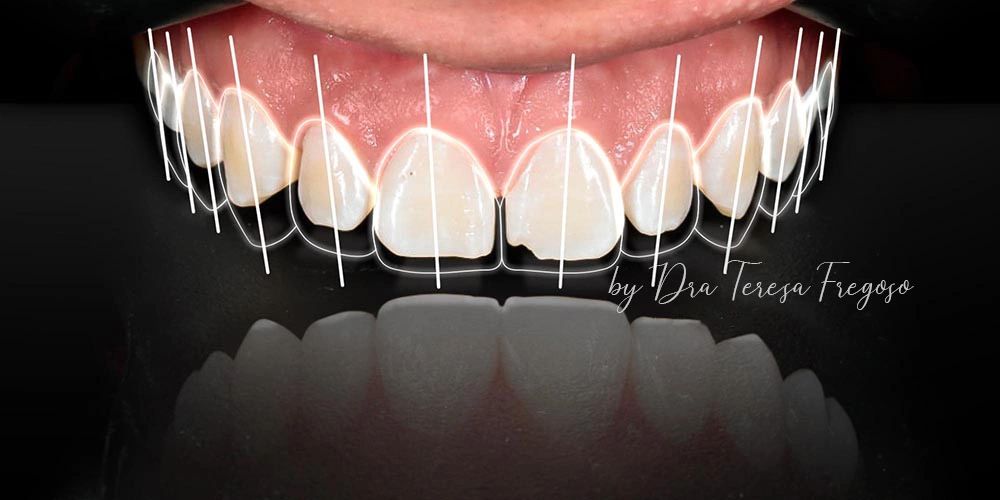 Diseño de Sonrisa, Odontología, Carillas dentales, Carillas de Resina, Diseño, Dientes, Smile Design