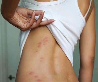 Bed Bug Bites
