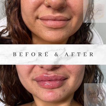 fuller lips before and after Marlborough, MA