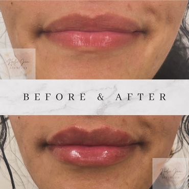 lip filler image Marlborough, ma