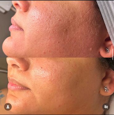 Dermaplane at Halie Jean Aesthetics in Marlborough, MA