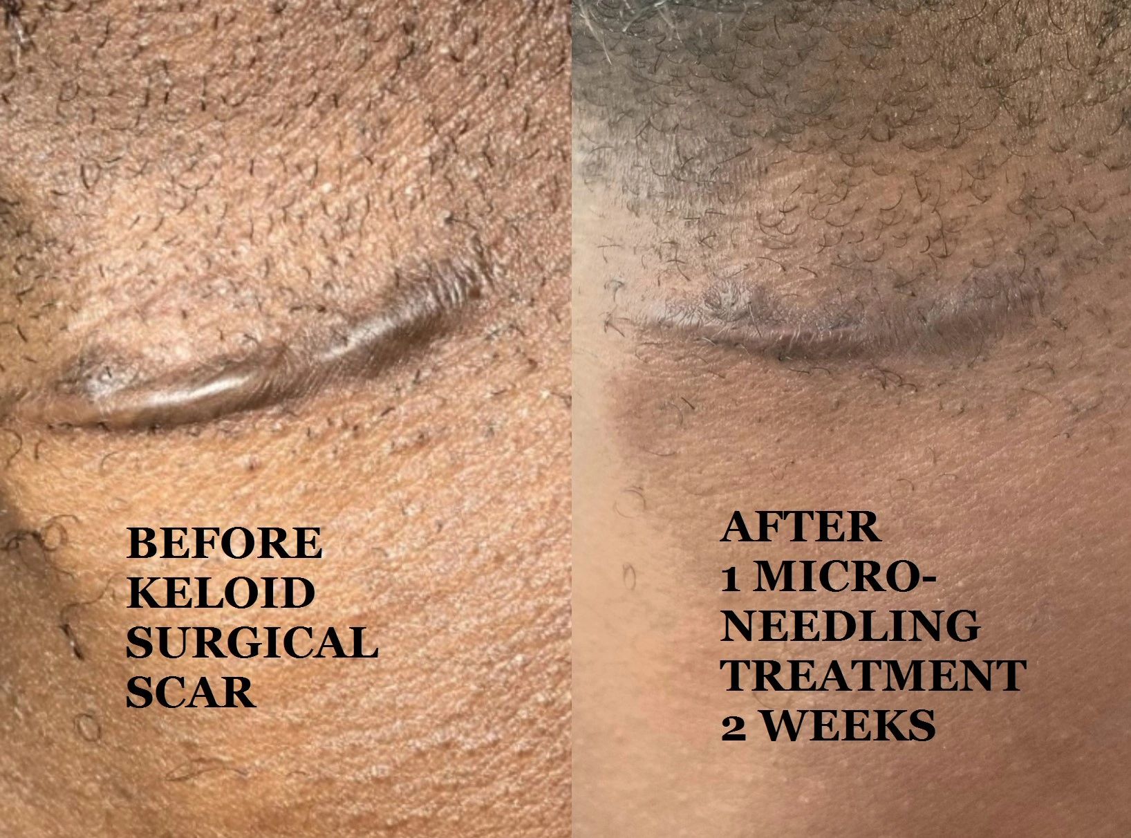 micro-needling, murfreesboro medspa, medical spa murfreesboro, reduce wrinkles, microdermabrasion