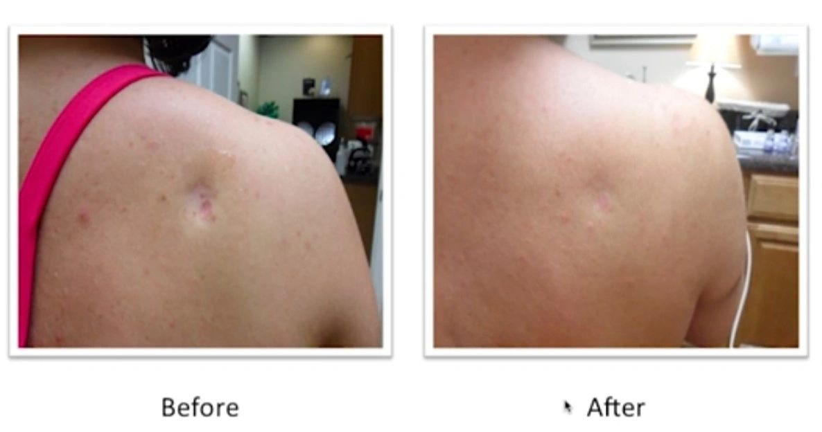 micro-needling, murfreesboro medspa, medical spa murfreesboro, reduce wrinkles, microdermabrasion