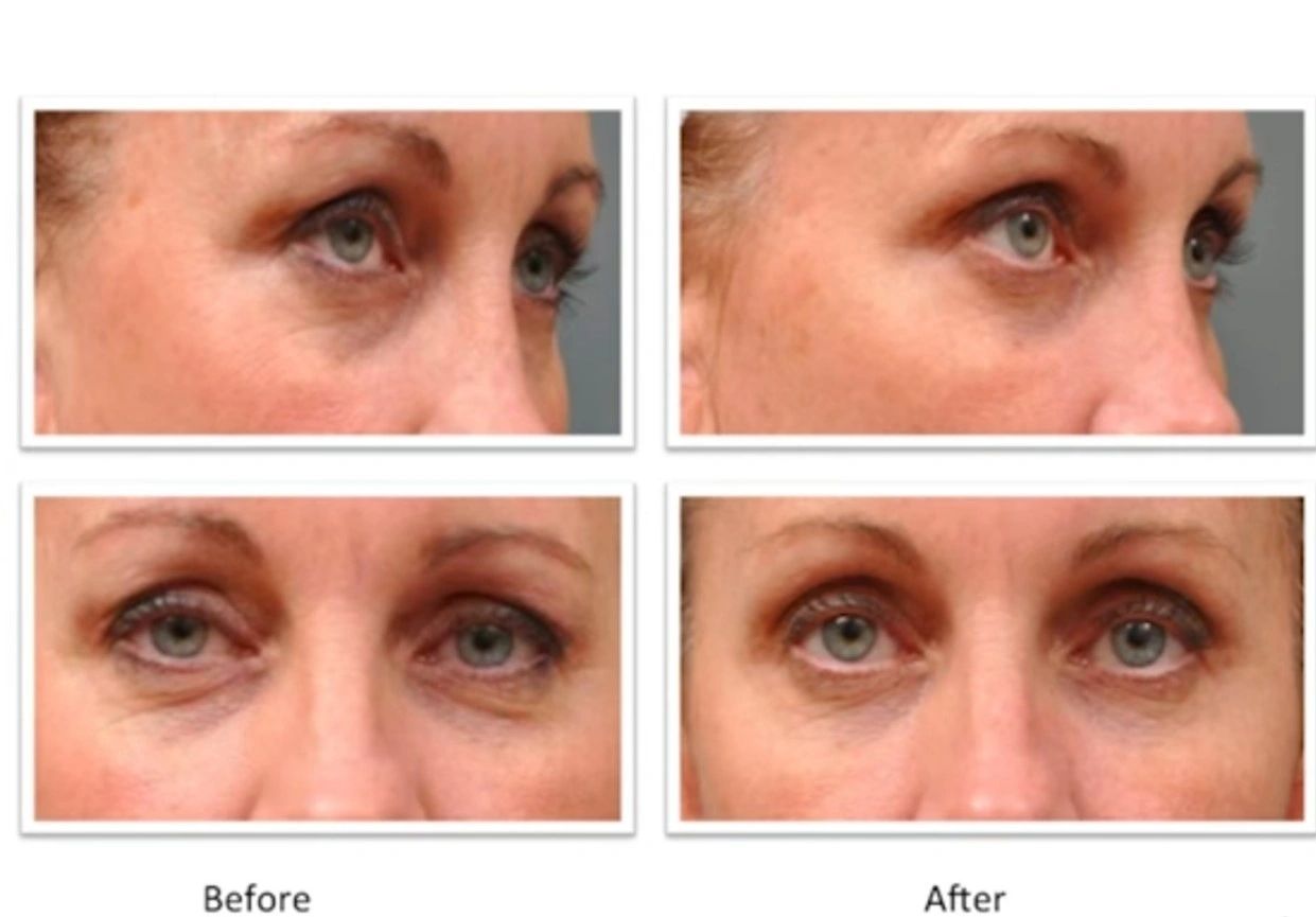 micro-needling, murfreesboro medspa, medical spa murfreesboro, reduce wrinkles, microdermabrasion