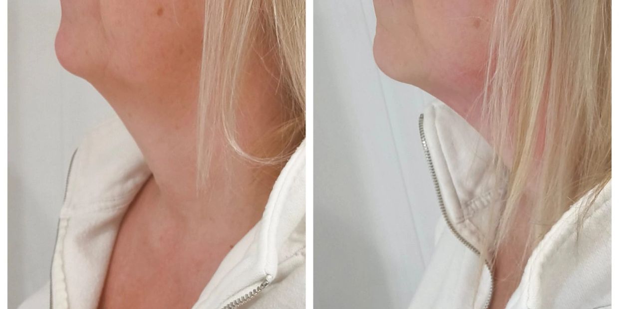 Side-by-side comparison of neck profiles before and after improvement.