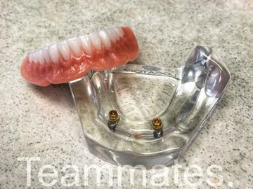 locator IMPLANT denture