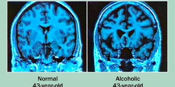 brain damage from alcohol