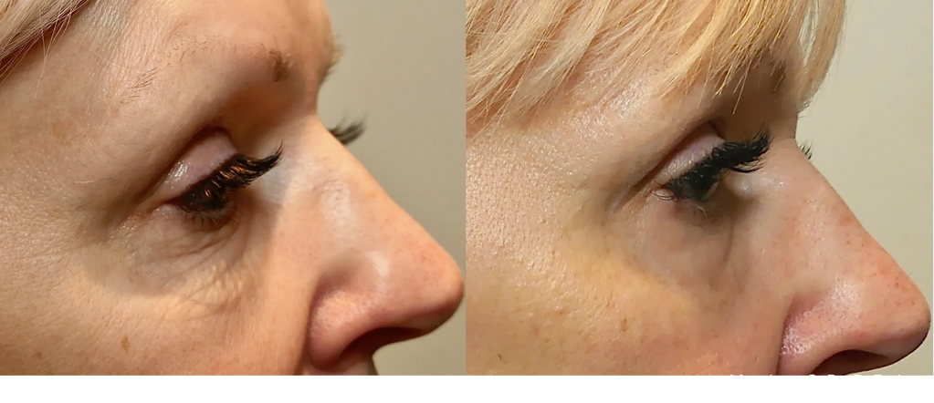 Morpheus 8 RF Microneedling with Blush Medspa and Laser Winter Garden Clermont, Windermere