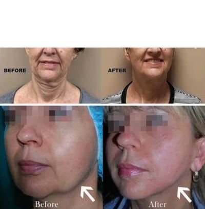 Morpheus 8 RF Microneedling tighter firmer skin Blush Medspa Laser Winter Garden Clermont Windermere