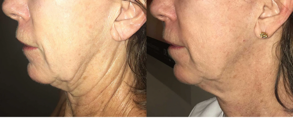 Morpheus 8 RF Microneedling with Blush Medspa and Laser Winter Garden Clermont, Windermere