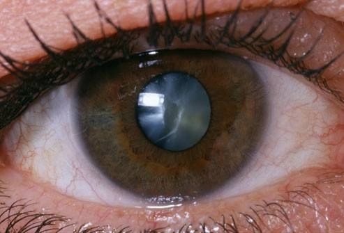 vision loss with cataract