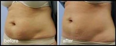 Fat dissolving before and after