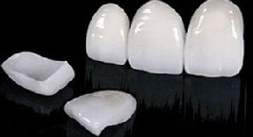 Imagem de um sorriso muito bonito, seguido de fotos de facetas de porcelana.