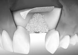 Imagem demonstrativa de uma cirurgia de enxertia com biomaterial e membrana.