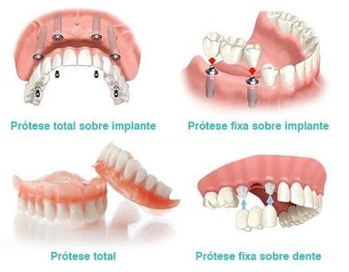 Exemplos de próteses sobre implantes e sobre dentes.