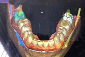 Planejamento da posição de 2 implantes feito sobre um escaneamento intra-oral.