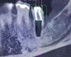 Imagem da tomografia com o planejamento digital e posicionamento 3D ideal.