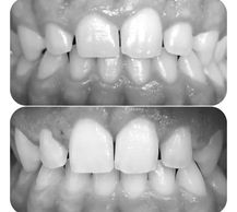 1) Foto inicial de um paciente com margens gengivais desarmônicas.
2) Foto após gengivoplastia.