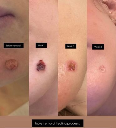 mole removal healing process