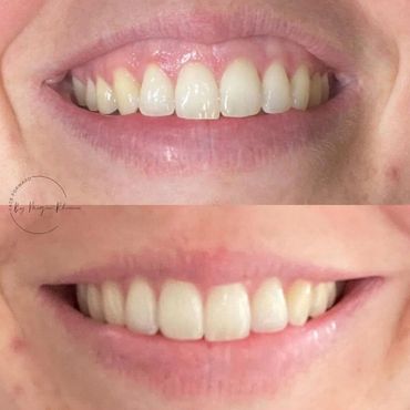 Gummy smile treatment