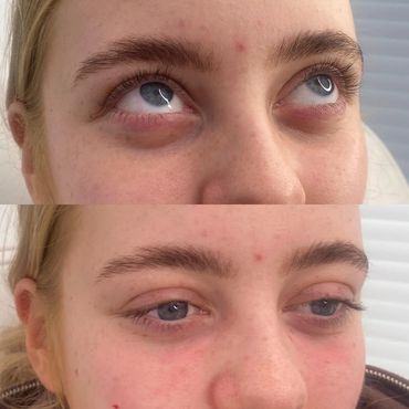 Lumi eyes skin boosters