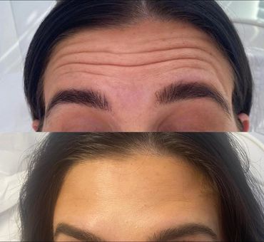 anti wrinkle injections to the forehead