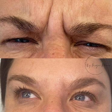 Frown line reduction using anti-wrinkle injections