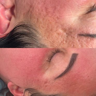 Vampire facial results reducing acne scarring